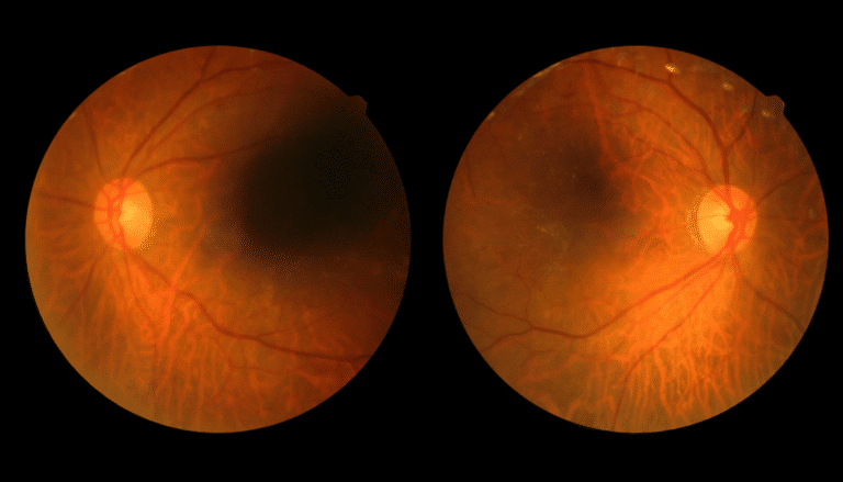 optomap retinal imaging