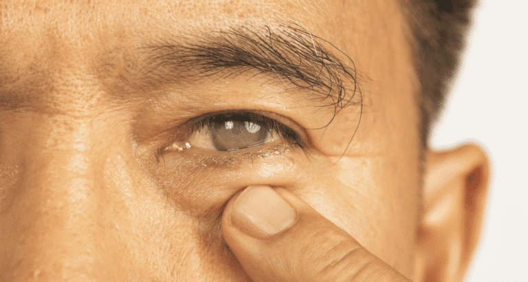 What are Some Common Eye Problems